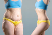Tummy tuck in Dubai – Dr Juan Carlos