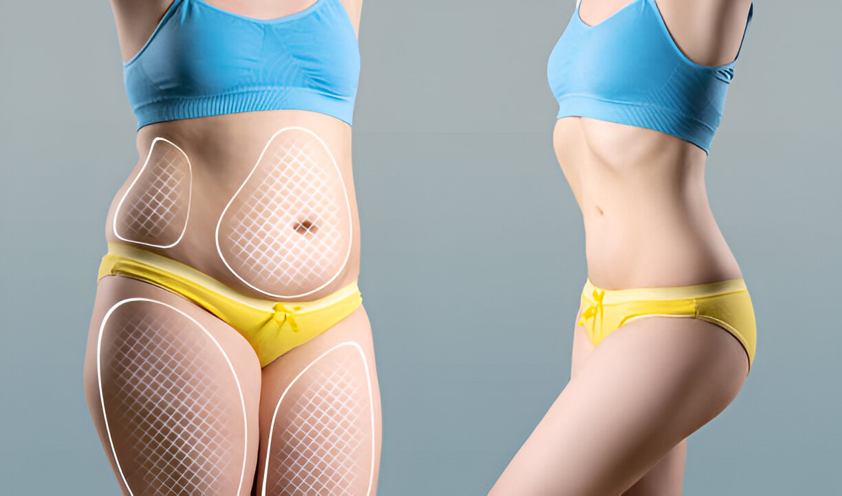 Tummy tuck in Dubai – Dr Juan Carlos