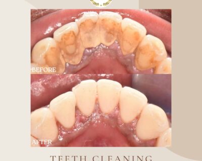 🦷-Renew-your-smile-with-teeth-whitening-at-American-Medical-Center-Our-advanced-treatments-wil